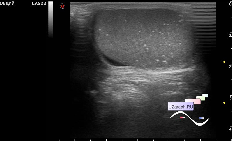 Уплотнение возле яичка. УЗИ картина микролитиаз яичка.