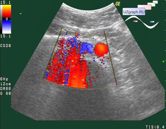 Узи с цдк брюшная. Сосуды брюшной полости допплерография. УЗИ сосудов брюшной полости. УЗДГ сосудов брюшной полости. Допплерография нижней полой вены.