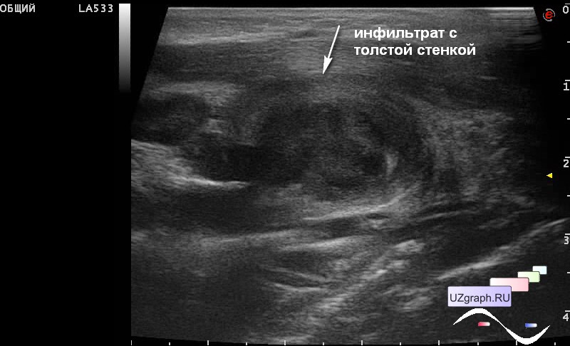 Инфильтрат на узи мягких тканей фото